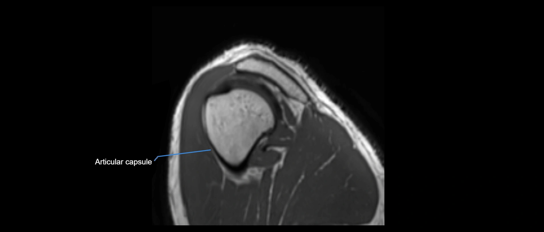 shoulder ligaments sagittal  cross sectional anatomy 3T MRI AI enhanced radiology image -img-00001-00049.webp